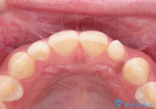 【矮小歯】オールセラミッククラウンの治療前