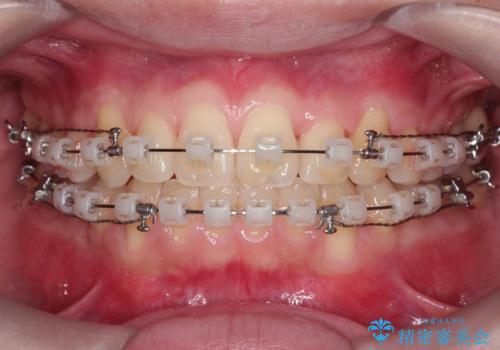 【クリア装置】前歯の凸凹を綺麗にしたいの治療中