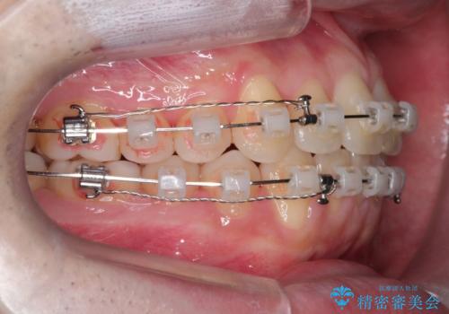 【クリア装置】前歯の凸凹を綺麗にしたいの治療中