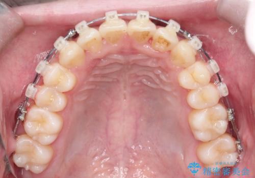 【クリア装置】前歯の凸凹を綺麗にしたいの治療中