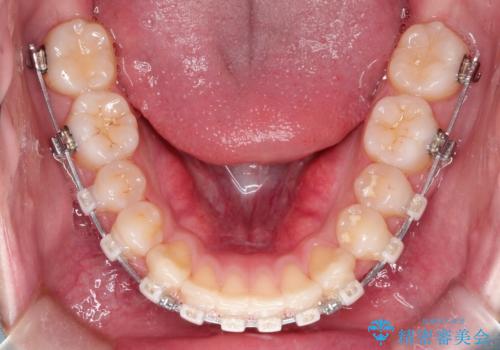 【クリア装置】前歯の凸凹を綺麗にしたいの治療中