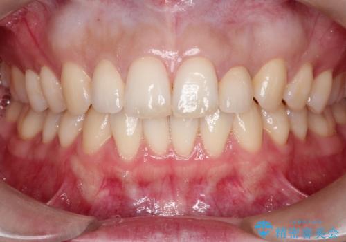 【矮小歯】オールセラミッククラウンの治療後