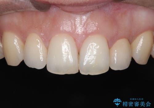 【矮小歯】オールセラミッククラウンの症例 治療後
