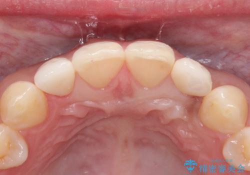 【矮小歯】オールセラミッククラウンの治療後