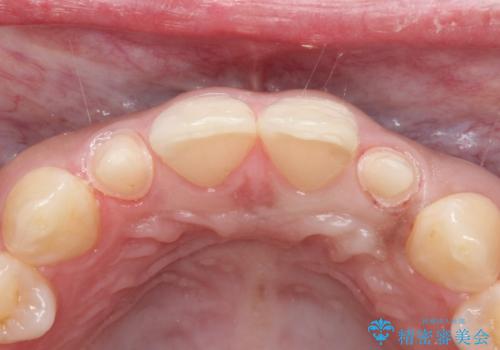 【矮小歯】オールセラミッククラウンの治療中