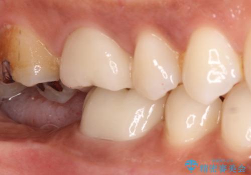 【オールセラミック】奥歯が痛い。根管治療〜被せ物治療の治療後
