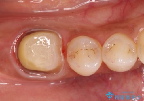 【オールセラミック】奥歯が痛い。根管治療〜被せ物治療の治療中