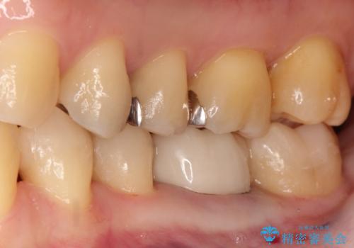 【メタルフリー】白い歯を手に入れたいの治療後