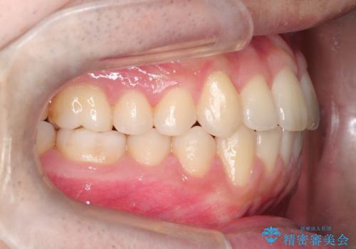 【クリア装置】前歯の凸凹を綺麗にしたいの治療後
