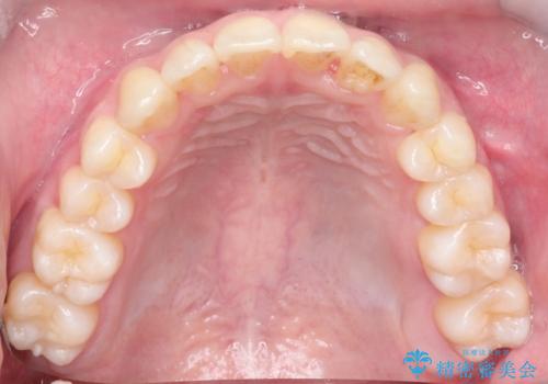 【クリア装置】前歯の凸凹を綺麗にしたいの治療後