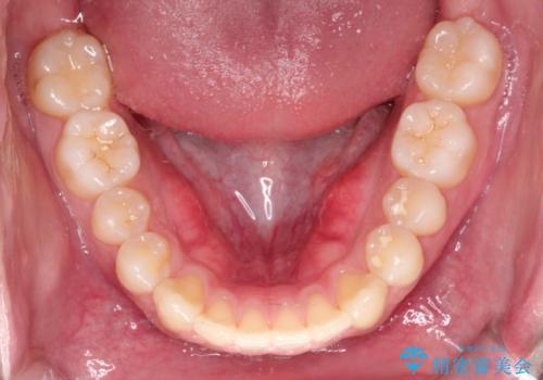 【クリア装置】前歯の凸凹を綺麗にしたいの治療後