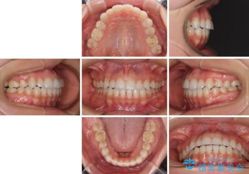 目立ちにくい抜歯矯正 ハーフリンガルの治療後