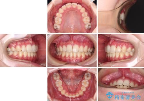 治療途中で転院 抜歯矯正の仕上げ治療の治療後