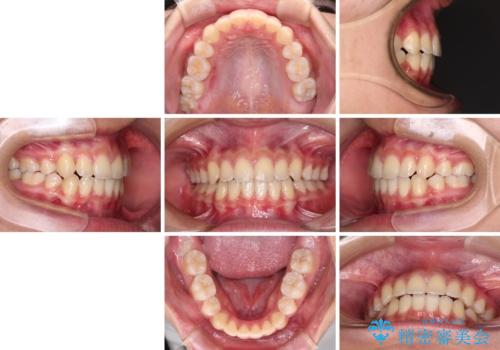気がつくと口が開いてしまう 閉じにくい口元改善の抜歯矯正の治療後