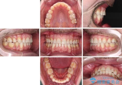 抜歯矯正の後戻りが気になる インビザライン・ライトによる矯正治療の治療後