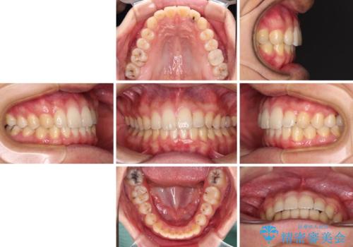 前歯のクロスバイトと抜歯が必要な奥歯の虫歯 インビザラインとインプラント治療の治療後