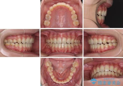 話しにくいオープンバイト ワイヤー装置による抜歯矯正治療の治療後