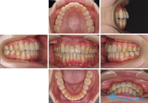 転んで前歯が欠けた 折れた前歯をきっかけに矯正治療で歯列をきれいに整えるの治療後