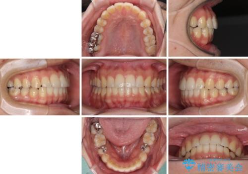 インビザライン・ライトによる矯正治療の後戻り改善の治療後