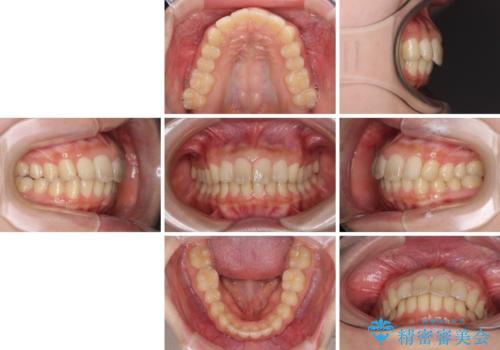 就職前にきれいな歯並びにしたい 大学生のインビザライン矯正の治療後