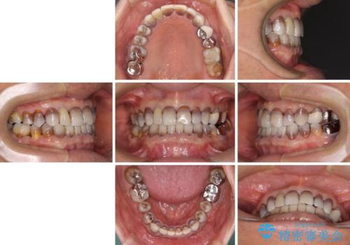 下の歯が前に出てしまう咬み合わせを治したい インビザラインによる矯正治療の治療後