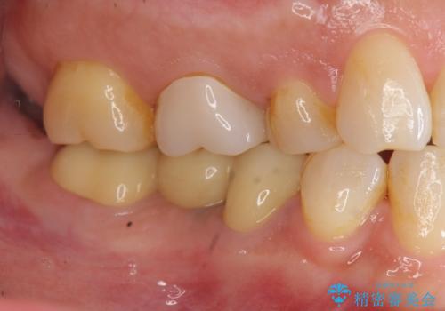 「ブリッジのところで噛むと痛い」 神経組織が原因の咬合痛の治療後