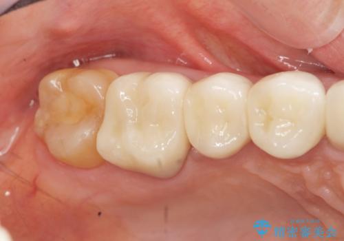 [ セラミック治療 ]歯の色が気になる　虫歯も治したいの治療後