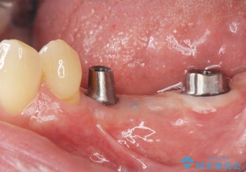 臼歯部インプラント補綴の治療中