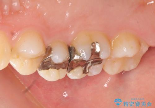銀歯を白くしたい　隙間がしみるの症例 治療前
