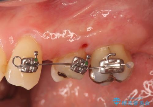 小矯正を伴う臼歯部ブリッジ治療の治療中
