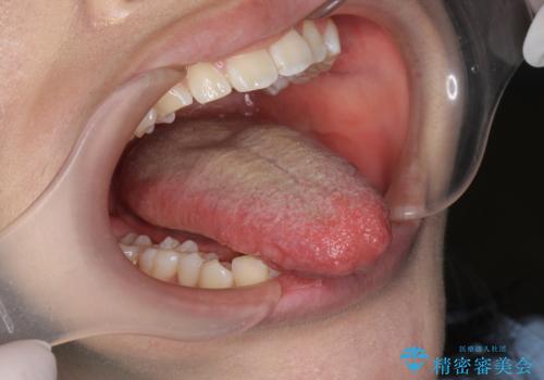 [ 舌小帯の形成 ]  滑舌が悪いと言われる、話しづらいの治療後