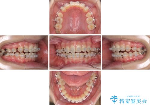 話しにくいオープンバイト ワイヤー装置による抜歯矯正治療の治療中