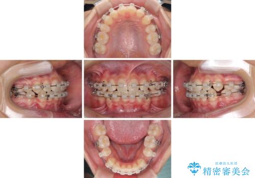 気がつくと口が開いてしまう 閉じにくい口元改善の抜歯矯正の治療中