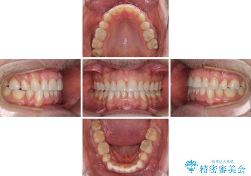 抜歯矯正の後戻りが気になる インビザライン・ライトによる矯正治療の治療中