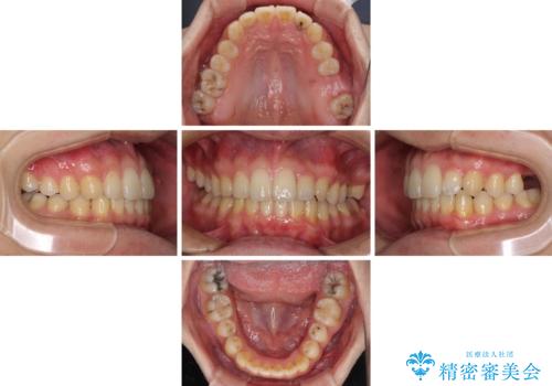 前歯のクロスバイトと抜歯が必要な奥歯の虫歯 インビザラインとインプラント治療の治療中