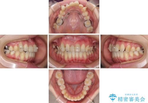転んで前歯が欠けた 折れた前歯をきっかけに矯正治療で歯列をきれいに整えるの治療中