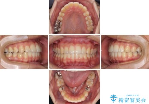 インビザライン・ライトによる矯正治療の後戻り改善の治療中