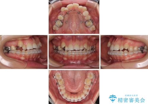 目立ちにくい抜歯矯正 ハーフリンガルの治療中