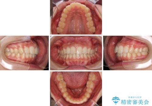 就職前にきれいな歯並びにしたい 大学生のインビザライン矯正の治療中