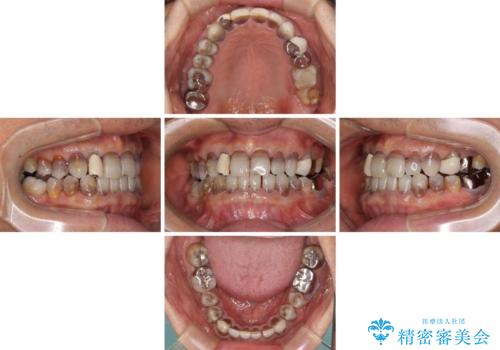 下の歯が前に出てしまう咬み合わせを治したい インビザラインによる矯正治療の治療中