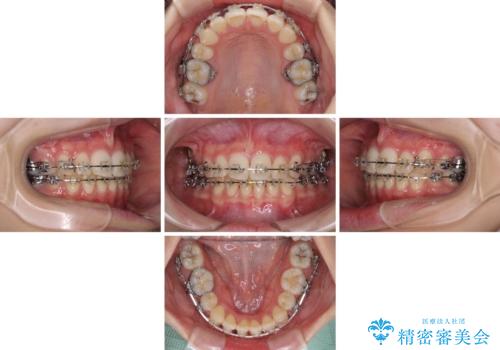 治療途中で転院 抜歯矯正の仕上げ治療の治療中