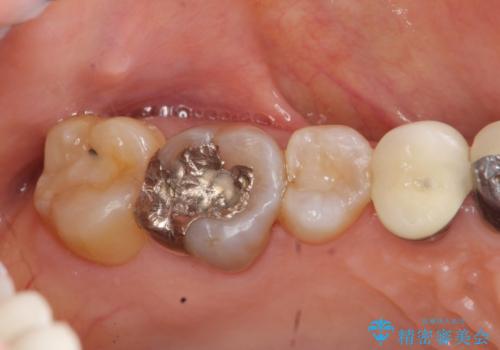 [ セラミック治療 ]歯の色が気になる　虫歯も治したいの治療前