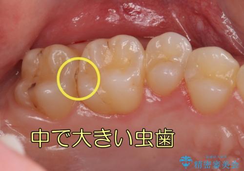 奥歯の虫歯 歯の間を広げてセラミックでしっかり治療