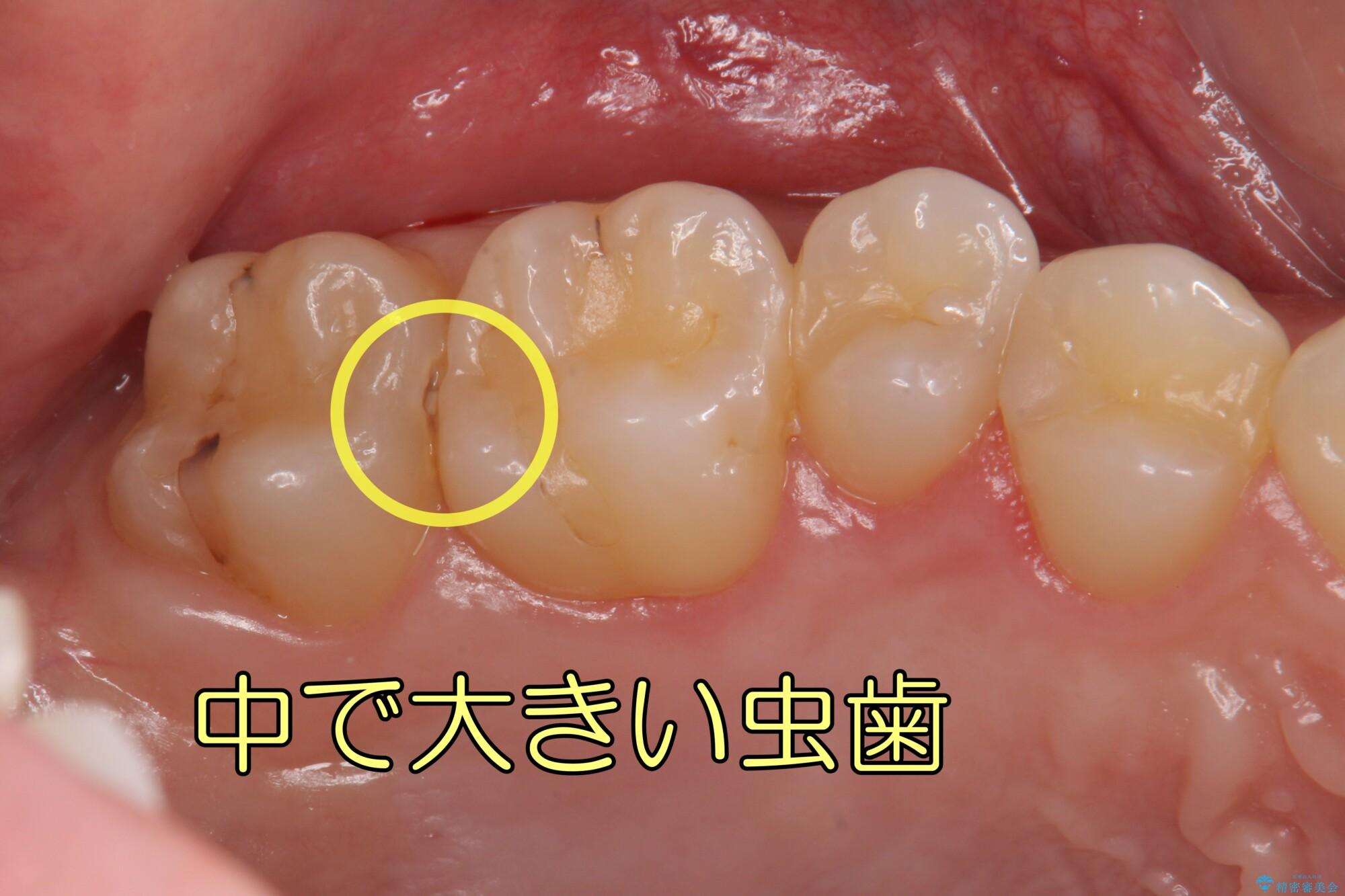 歯 と 歯 の 間 虫歯