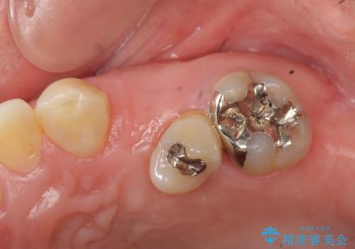小矯正を伴う臼歯部ブリッジ治療の治療前