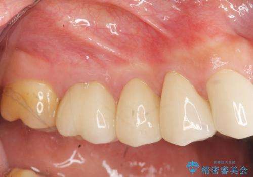 [ セラミック治療 ]歯の色が気になる　虫歯も治したいの症例 治療後