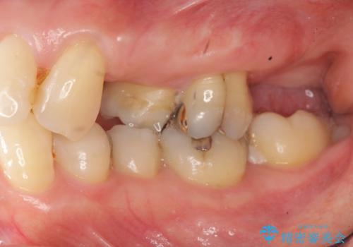 小矯正を伴う臼歯部ブリッジ治療の治療前