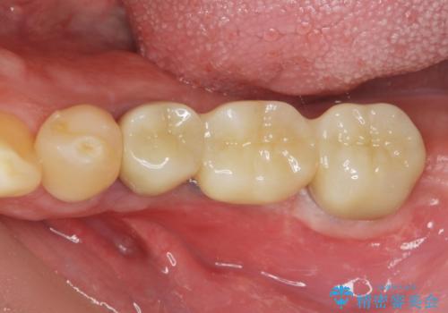 臼歯部インプラント補綴の治療後