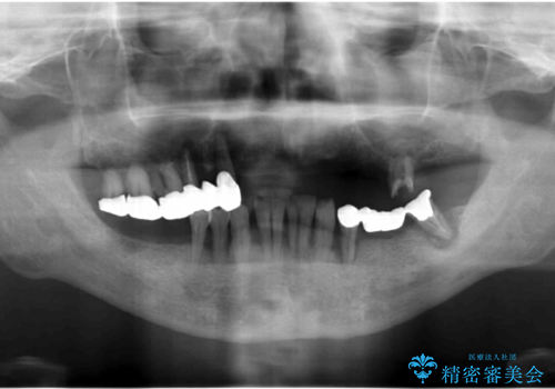 歯がないまま放置していた 奥歯のインプラント 50代男性の治療前