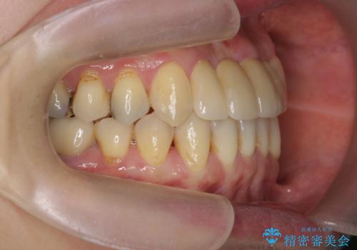 [ 矯正と補綴、総合歯科治療 ]  クロスバイトを避ける前歯部審美ブリッジの治療後